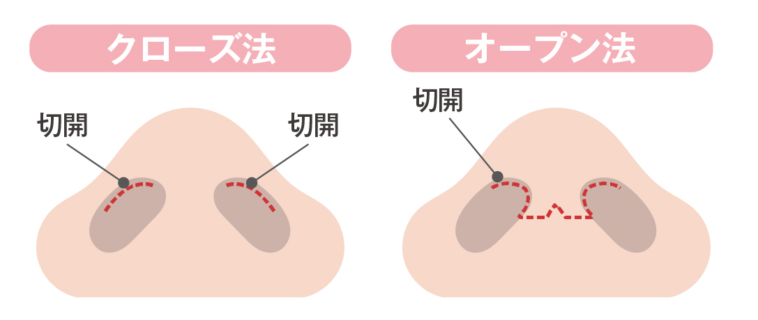 クローズ法・オープン法
