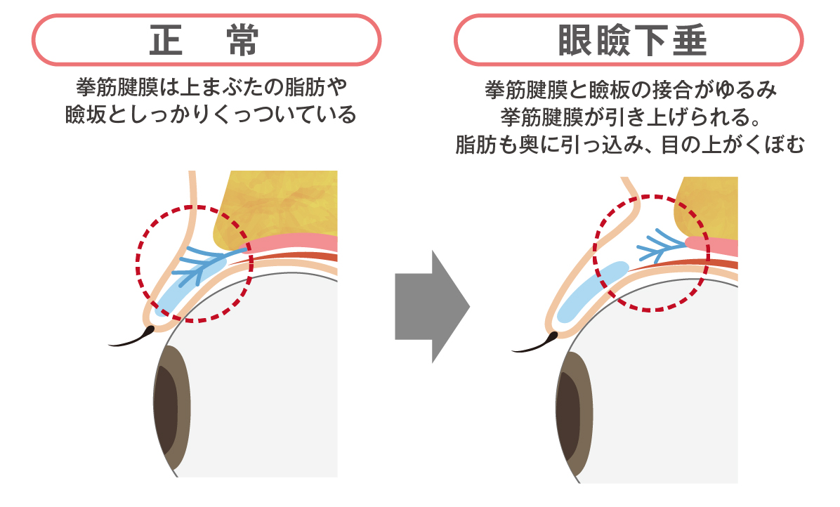 眼瞼下垂（がんけんかすい）