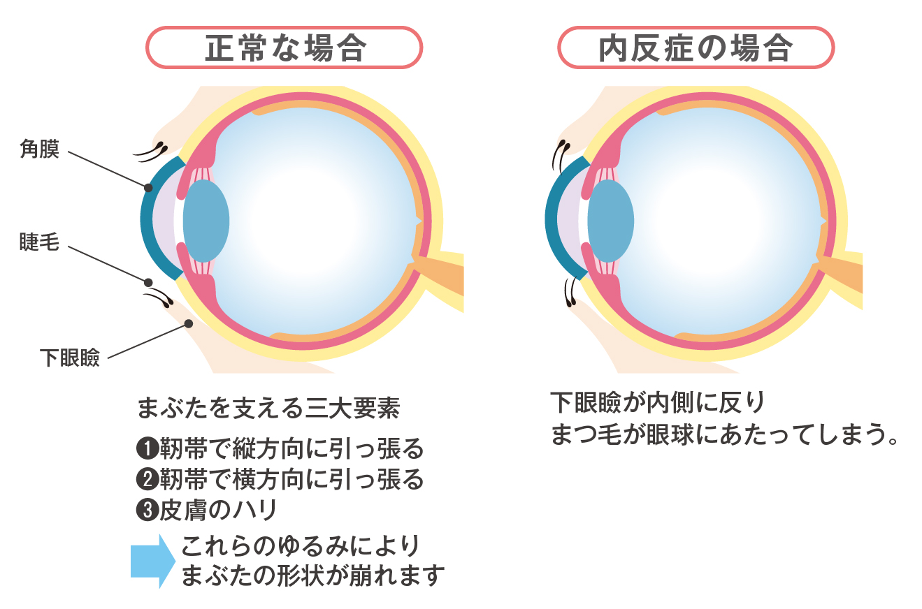 後天性の逆さまつ毛