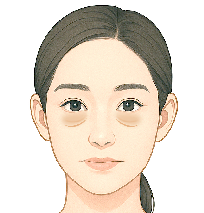 目の下に膨らみと凹みの両方がある場合
