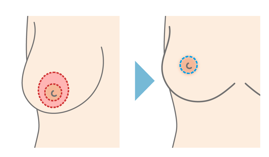 ドーナツ型（乳輪周囲切開法）