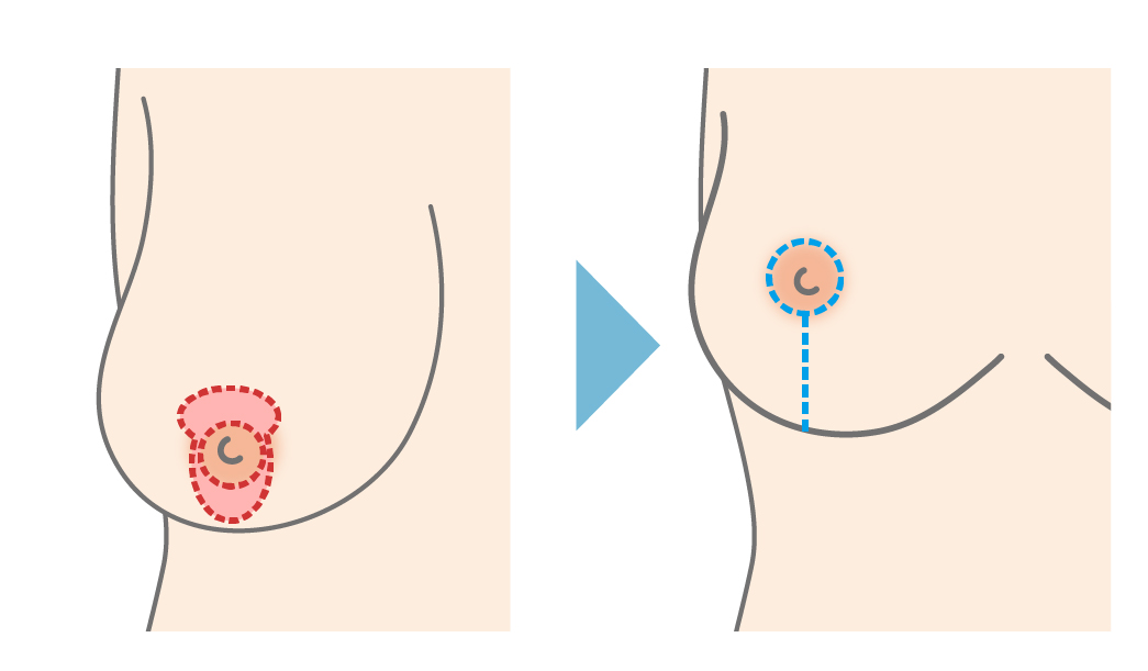 ロリーポップ型（垂直切開法）