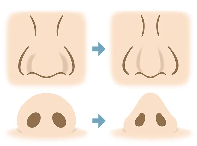 鼻整形メニュー