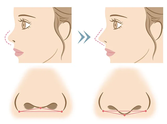 鼻整形メニュー