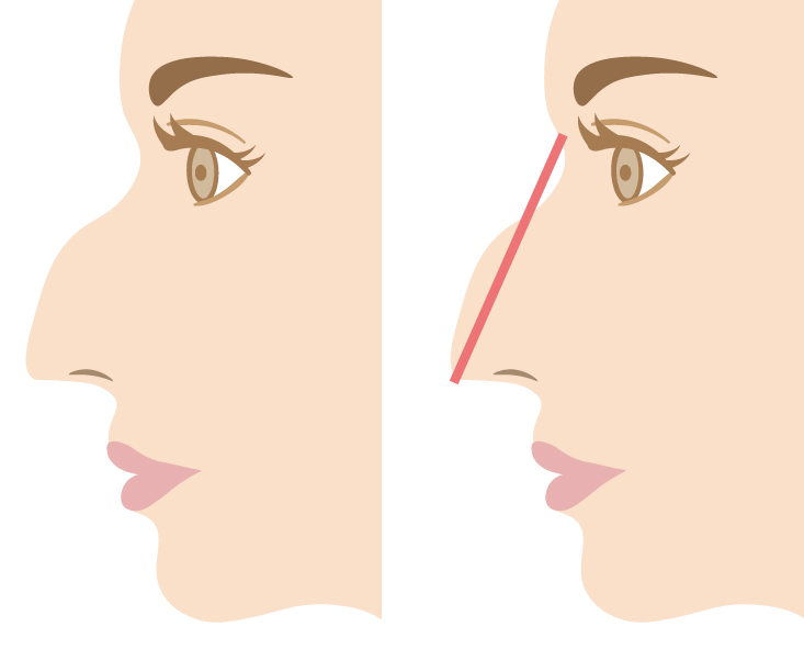 わし鼻の理想の程度