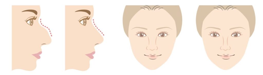 こんなに横顔の印象が変わります