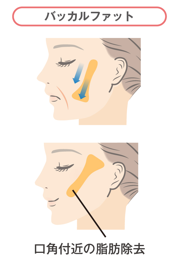 バッカルファット除去について