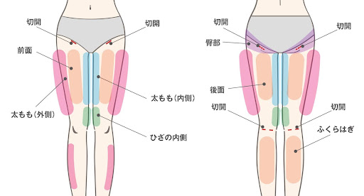下肢の脂肪吸引の吸引範囲