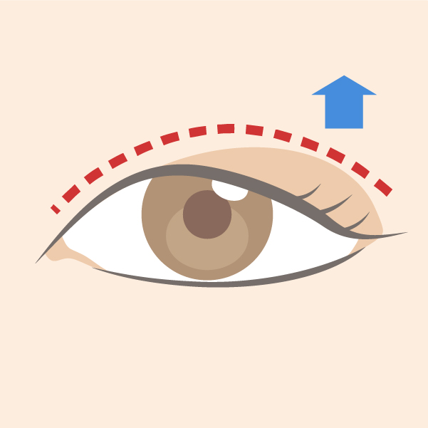 眼瞼下垂の再手術