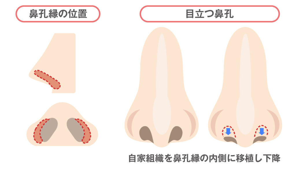 鼻孔縁挙上術・鼻孔縁下降術(フェイスラインも含む）