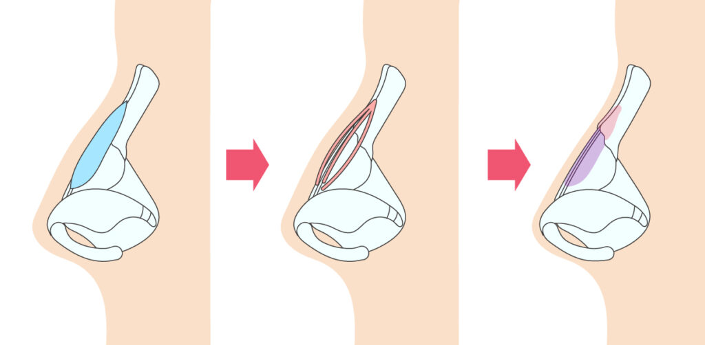 わし鼻修正について