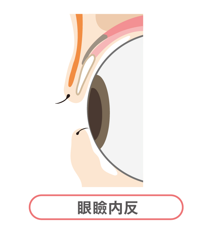 眼瞼内反 (がんけんないはん)