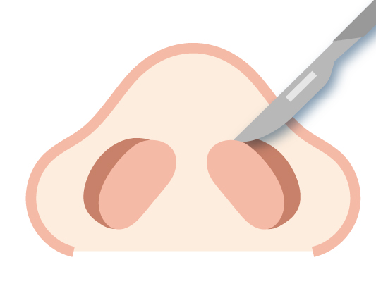 2.鼻孔縁を切除