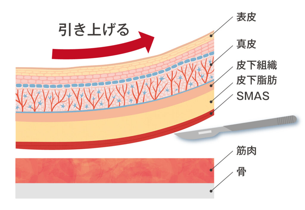 フェイスリフトの仕組み