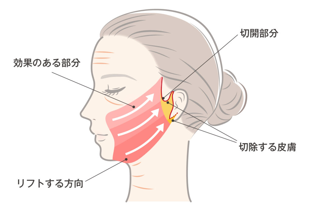 フェイスリフト施術説明