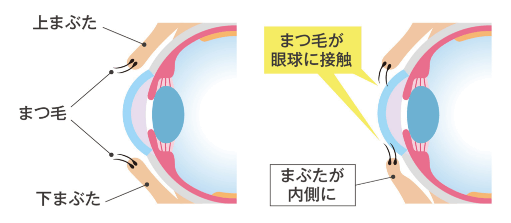 逆さまつ毛の問題
