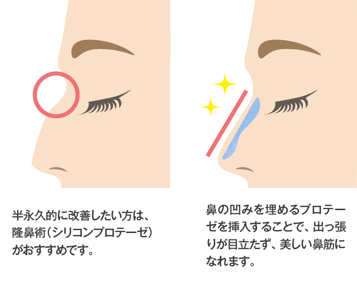【隆鼻術（シリコンプロテーゼ）