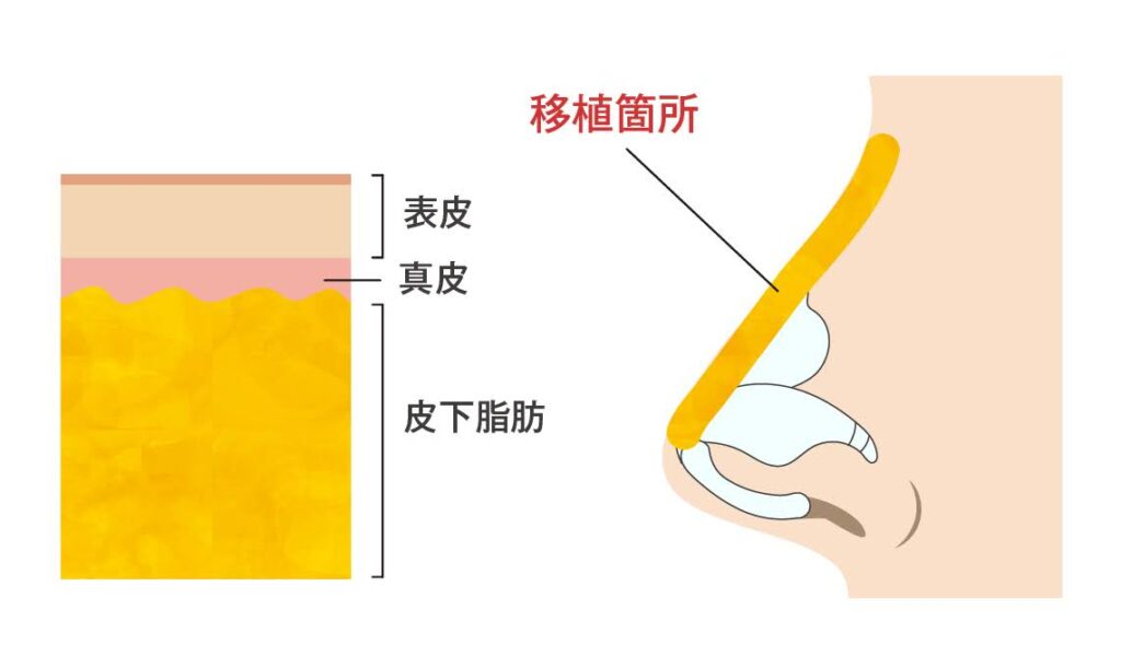 真皮脂肪移植を使用する方法