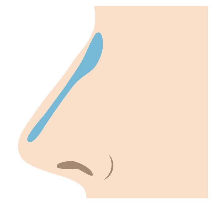 シリコン製プロテーゼを用いる方法