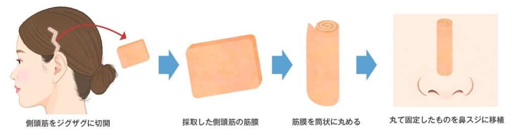 耳介軟骨＋筋膜を使用する方法