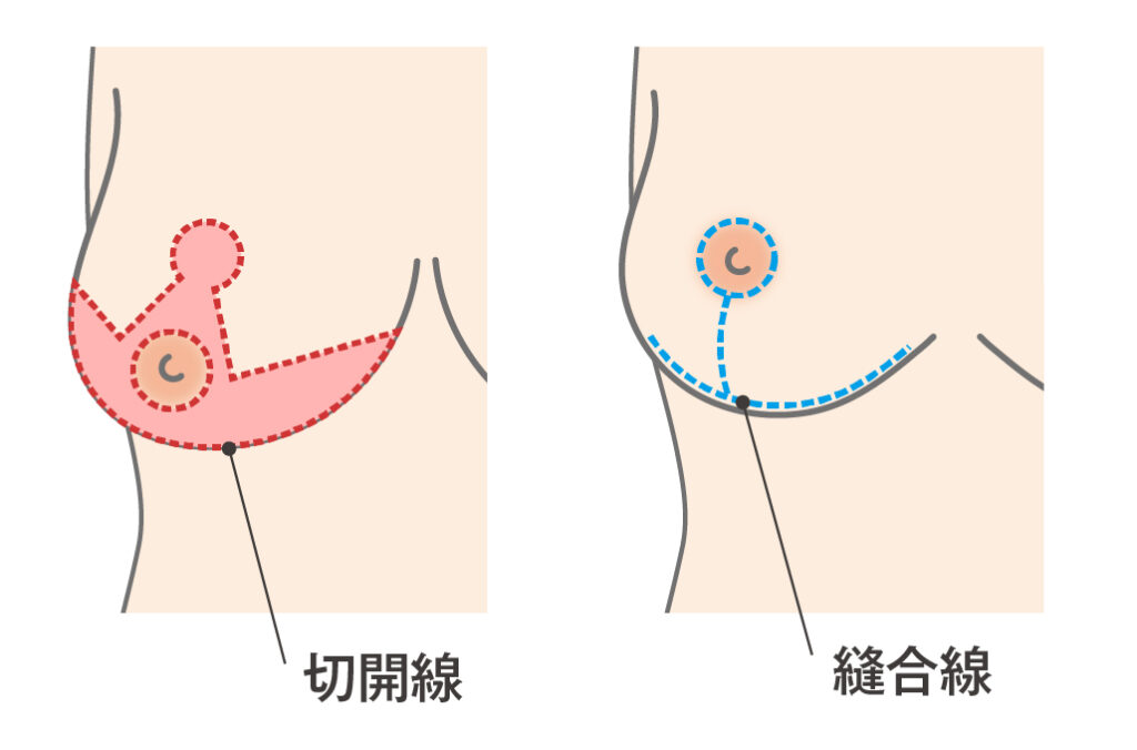 乳房縮小術マッキソック法