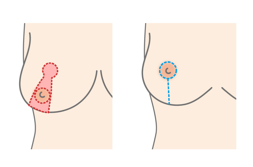 乳房吊上術（バストリフトアップ）