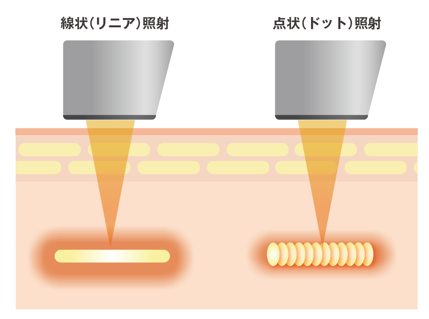 ウルトラフォーマーMPT