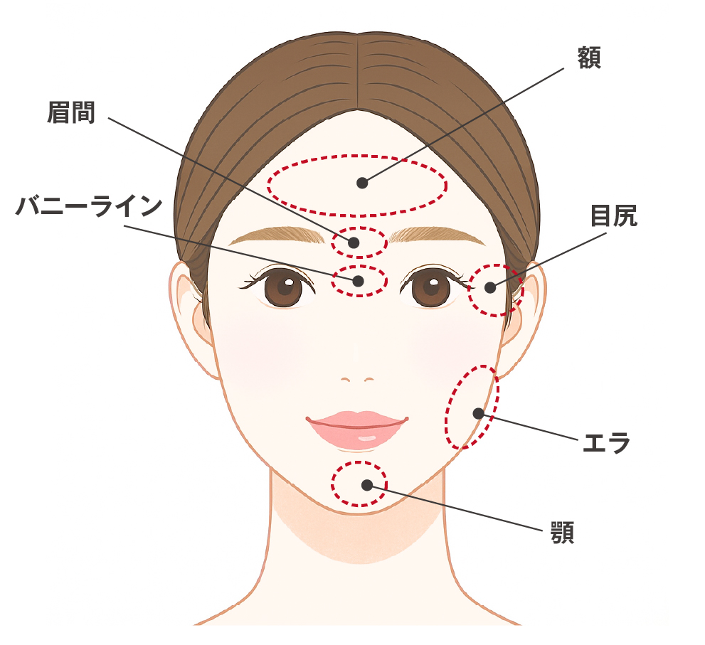 ボトックス注射とは