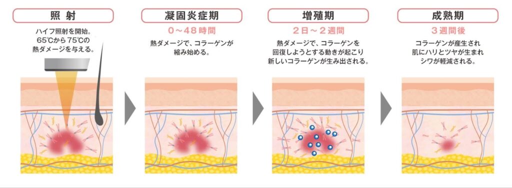 ウルトラフォーマーMPT