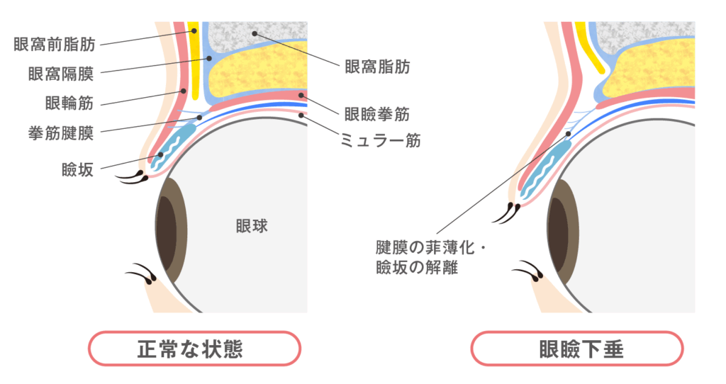 腱膜性眼瞼下垂症