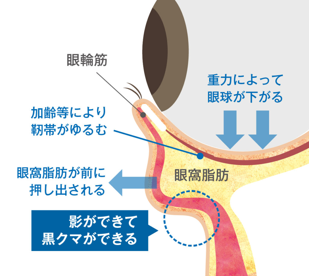 クマができる原因のイラスト